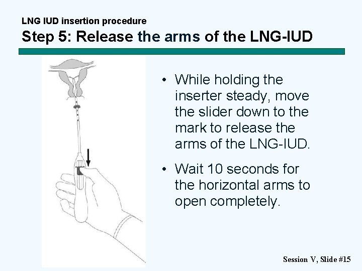 LNG IUD insertion procedure Step 5: Release the arms of the LNG-IUD • While