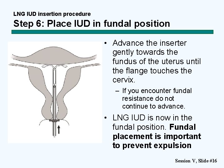LNG IUD insertion procedure Step 6: Place IUD in fundal position • Advance the