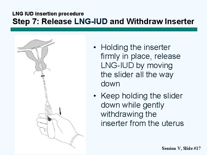 LNG IUD insertion procedure Step 7: Release LNG-IUD and Withdraw Inserter • Holding the