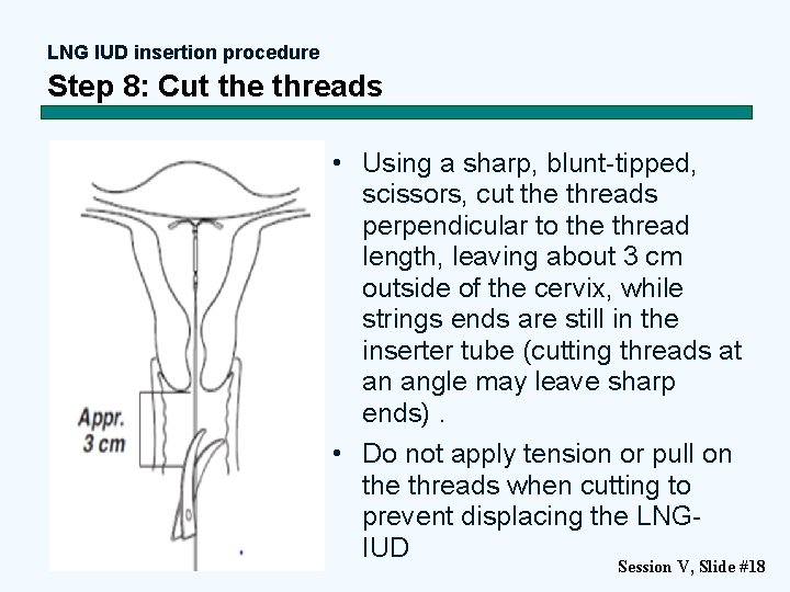 LNG IUD insertion procedure Step 8: Cut the threads • Using a sharp, blunt-tipped,