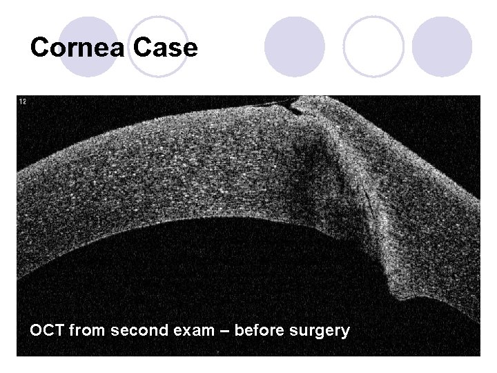 Cornea Case OCT from second exam – before surgery 