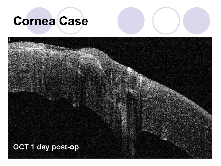 Cornea Case OCT 1 day post-op 