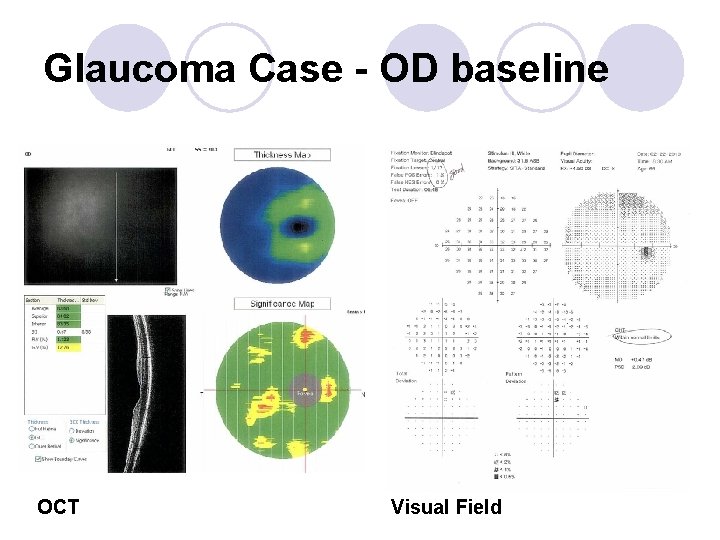Glaucoma Case - OD baseline OCT Visual Field 