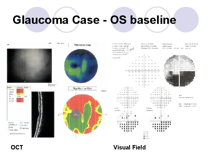 Glaucoma Case - OS baseline OCT Visual Field 