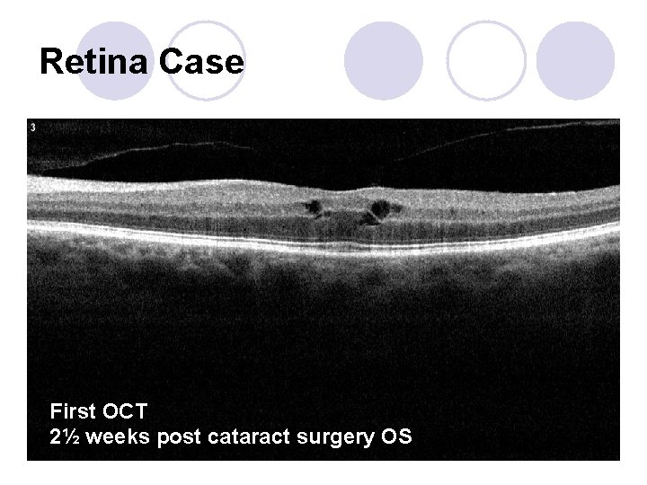 Retina Case First OCT 2½ weeks post cataract surgery OS 