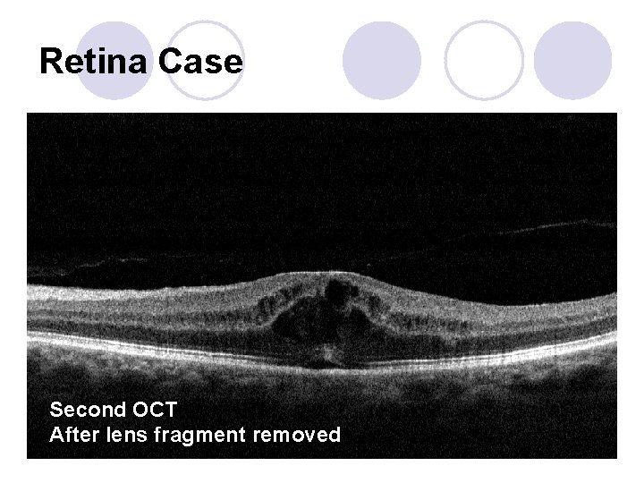 Retina Case Second OCT After lens fragment removed 