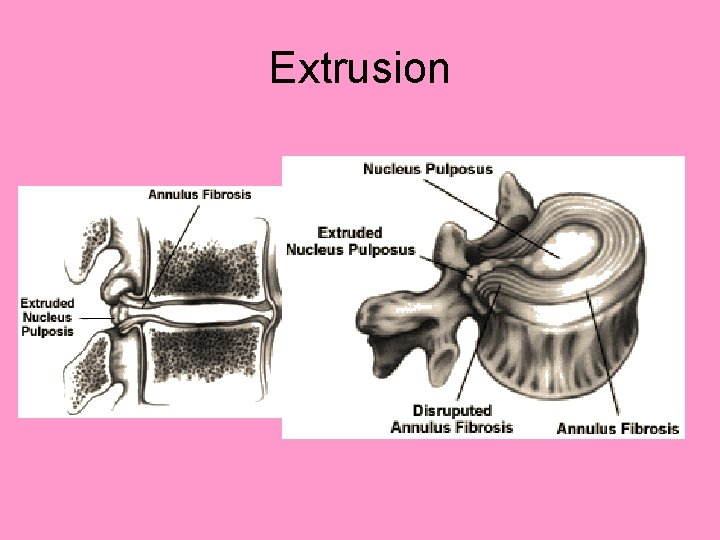 LUMBAR SPINE Bony Anatomy Made of two parts