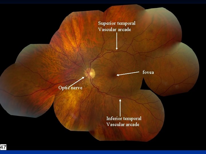 Superior temporal Vascular arcade fovea Optic nerve Inferior temporal Vascular arcade 