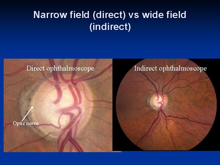 Narrow field (direct) vs wide field (indirect) Direct ophthalmoscope Optic nerve Indirect ophthalmoscope 