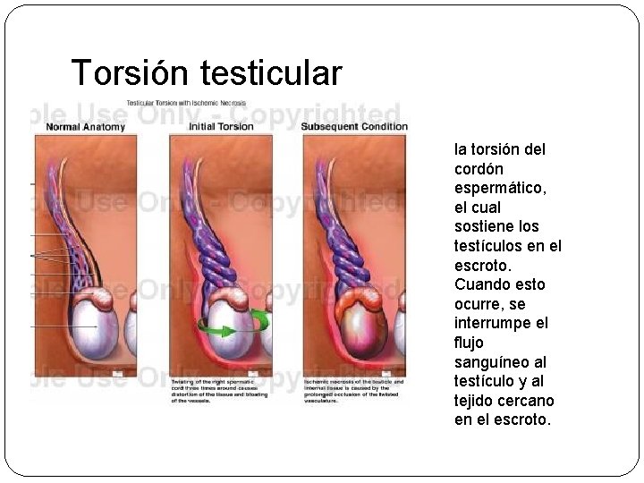 Torsión testicular la torsión del cordón espermático, el cual sostiene los testículos en el