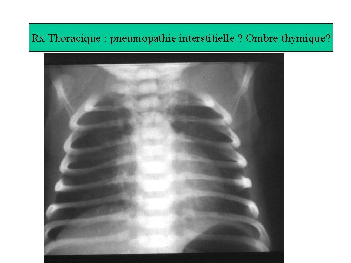 Radiographie du thorax (voit on l’ombre Rx Thoracique du thymus: pneumopathie interstitielle ? Ombre