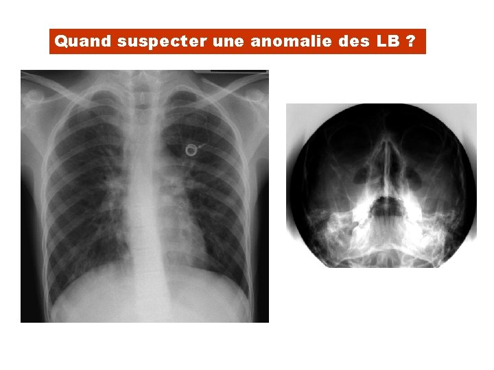 Quand suspecter une anomalie des LB ? 