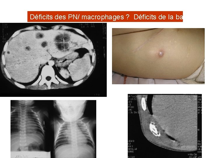 Déficits des PN/ macrophages ? Déficits de la bactéricidie 