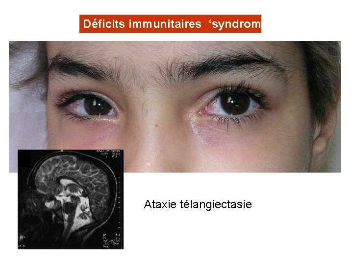 Déficits immunitaires ‘syndromiques’ Ataxie télangiectasie 