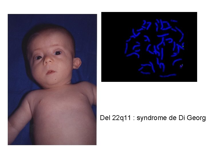 Del 22 q 11 : syndrome de Di George 