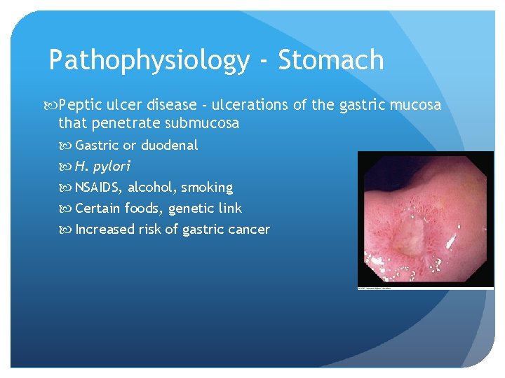Pathophysiology - Stomach Peptic ulcer disease - ulcerations of the gastric mucosa that penetrate