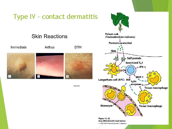 Type IV – contact dermatitis 