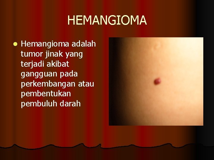 HEMANGIOMA l Hemangioma adalah tumor jinak yang terjadi akibat gangguan pada perkembangan atau pembentukan