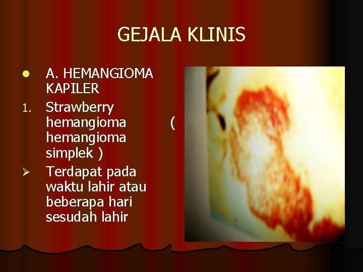 GEJALA KLINIS A. HEMANGIOMA KAPILER 1. Strawberry hemangioma simplek ) Ø Terdapat pada waktu