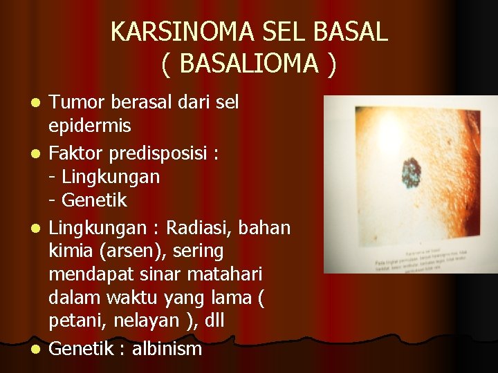 KARSINOMA SEL BASAL ( BASALIOMA ) l l Tumor berasal dari sel epidermis Faktor