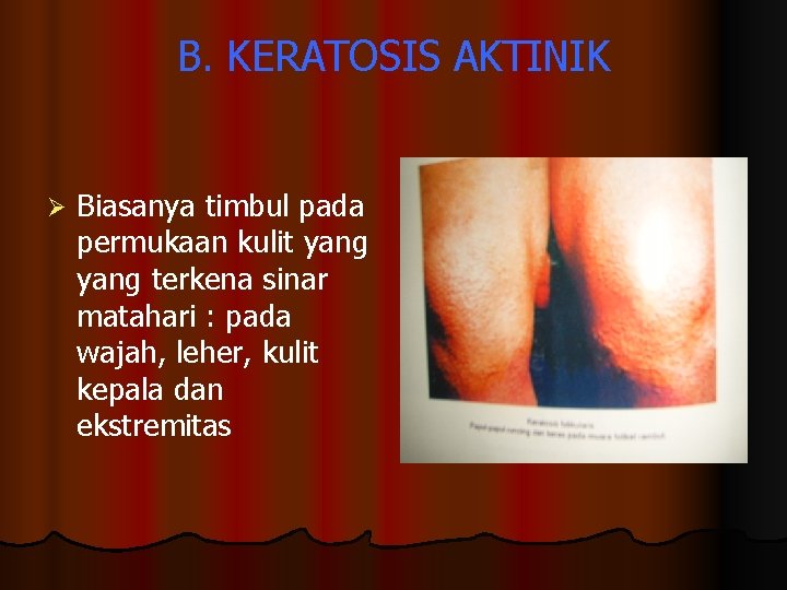 B. KERATOSIS AKTINIK Ø Biasanya timbul pada permukaan kulit yang terkena sinar matahari :
