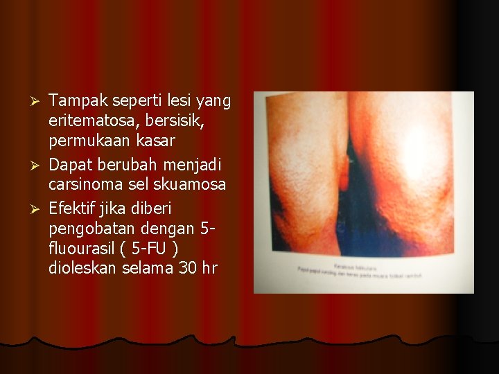 Tampak seperti lesi yang eritematosa, bersisik, permukaan kasar Ø Dapat berubah menjadi carsinoma sel