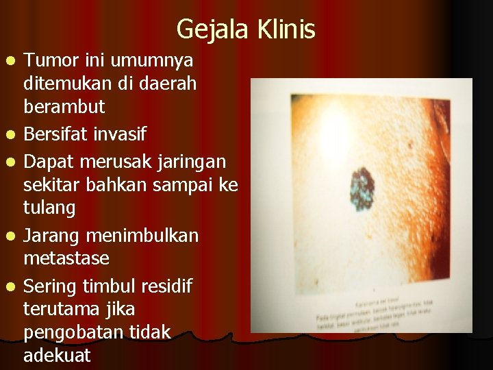 Gejala Klinis l l l Tumor ini umumnya ditemukan di daerah berambut Bersifat invasif