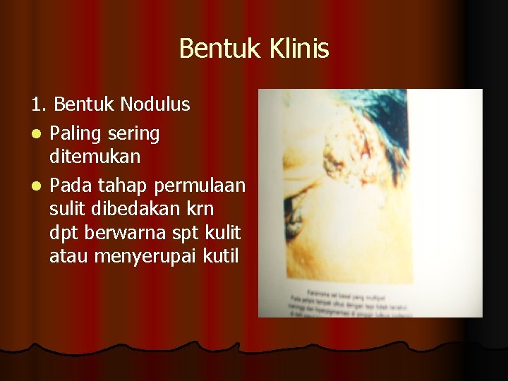 Bentuk Klinis 1. Bentuk Nodulus l Paling sering ditemukan l Pada tahap permulaan sulit