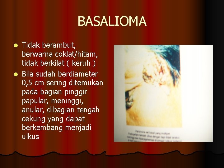 BASALIOMA Tidak berambut, berwarna coklat/hitam, tidak berkilat ( keruh ) l Bila sudah berdiameter