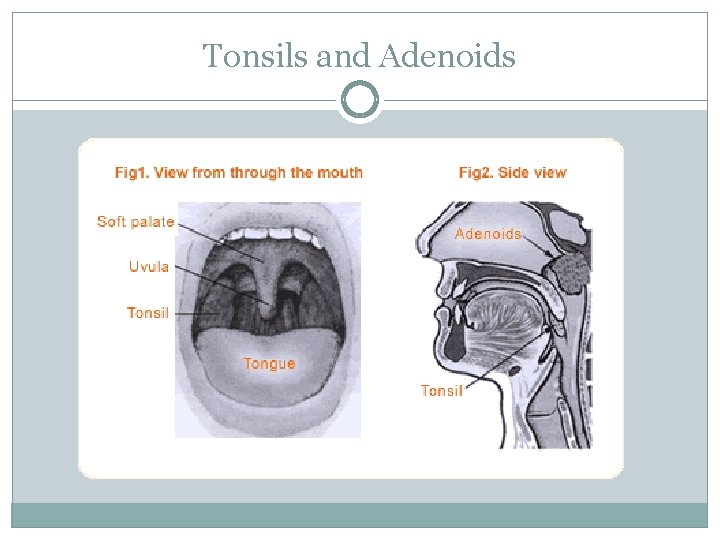 Tonsils and Adenoids 