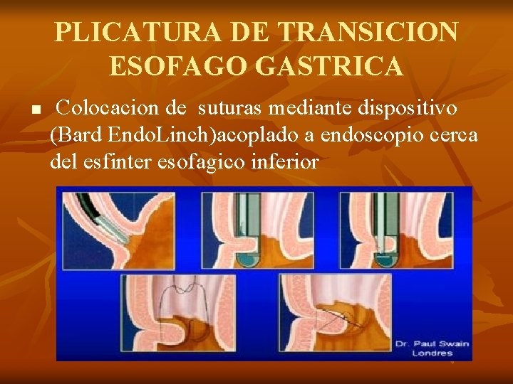 PLICATURA DE TRANSICION ESOFAGO GASTRICA n Colocacion de suturas mediante dispositivo (Bard Endo. Linch)acoplado