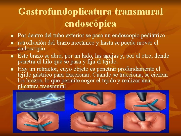 Gastrofundoplicatura transmural endoscópica n n Por dentro del tubo exterior se pasa un endoscopio