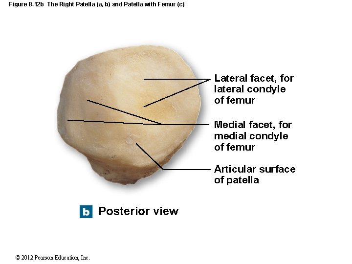 Figure 8 -12 b The Right Patella (a, b) and Patella with Femur (c)