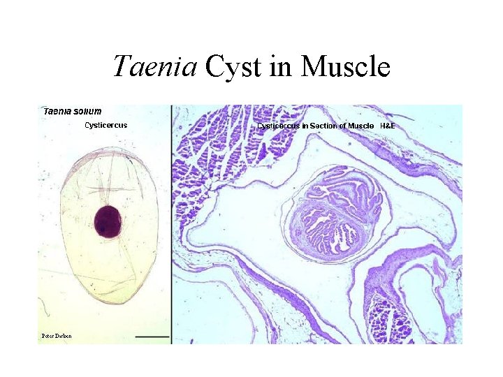 Taenia Cyst in Muscle 