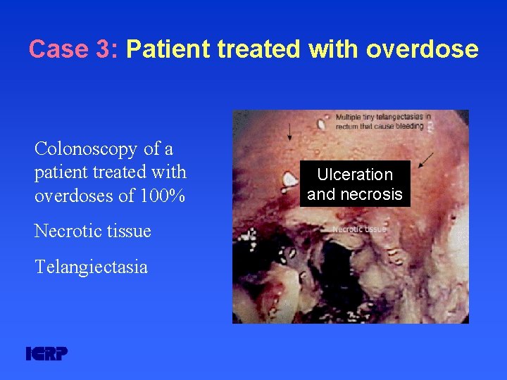 Case 3: Patient treated with overdose Colonoscopy of a patient treated with overdoses of Case 3: Patient treated with overdose Colonoscopy of a patient treated with overdoses of