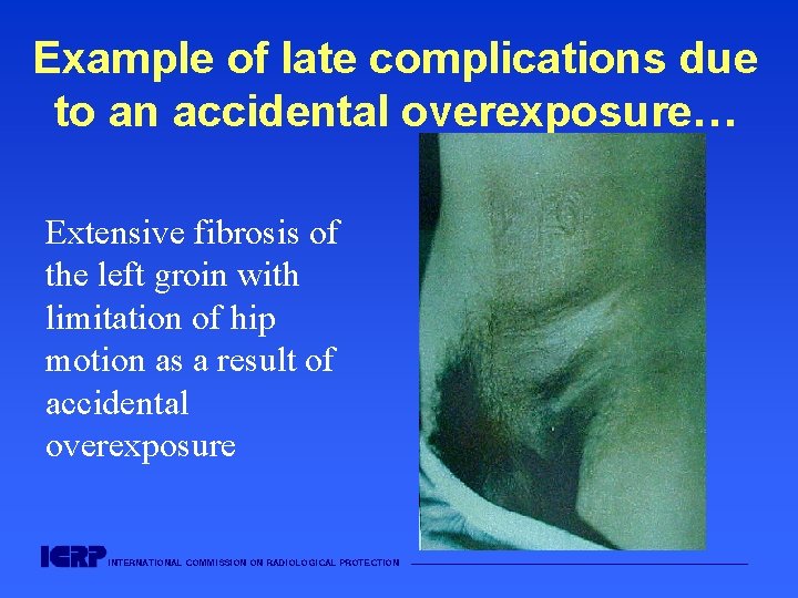 Example of late complications due to an accidental overexposure… Extensive fibrosis of the left Example of late complications due to an accidental overexposure… Extensive fibrosis of the left