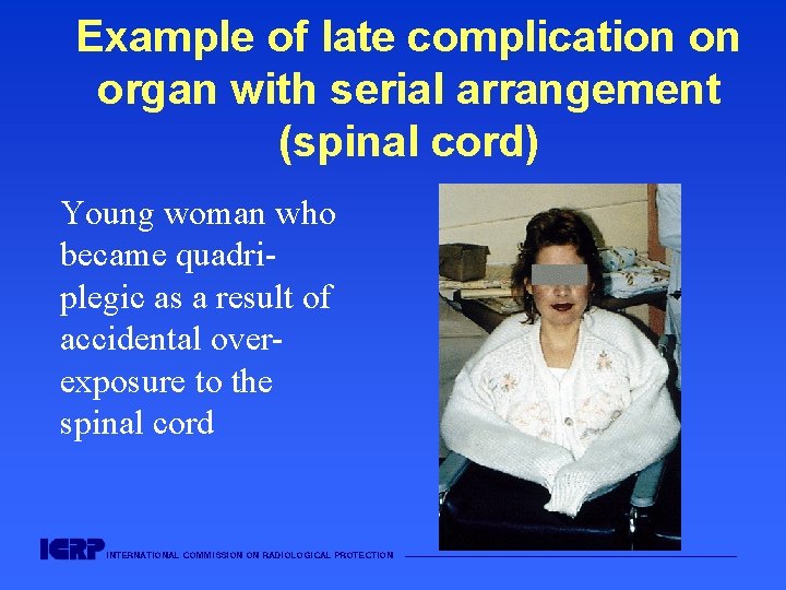 Example of late complication on organ with serial arrangement (spinal cord) Young woman who Example of late complication on organ with serial arrangement (spinal cord) Young woman who