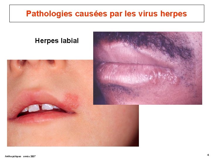 Pathologies causées par les virus herpes Herpes labial Antiherpétiques - année 2007 4 