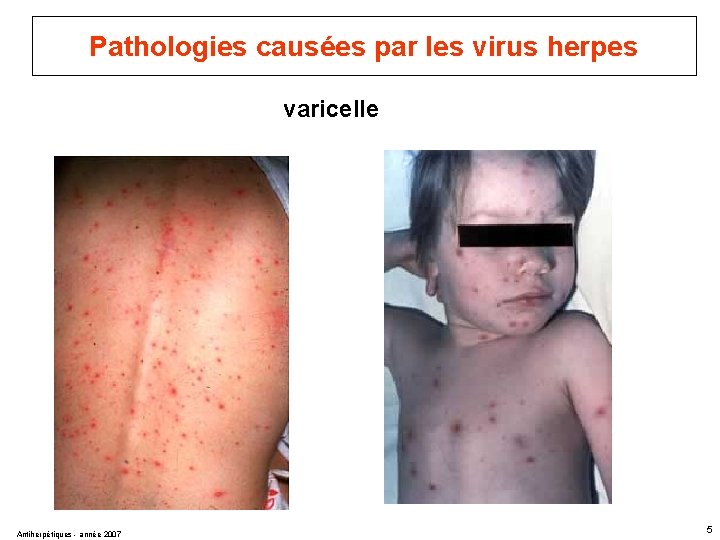 Pathologies causées par les virus herpes varicelle Antiherpétiques - année 2007 5 
