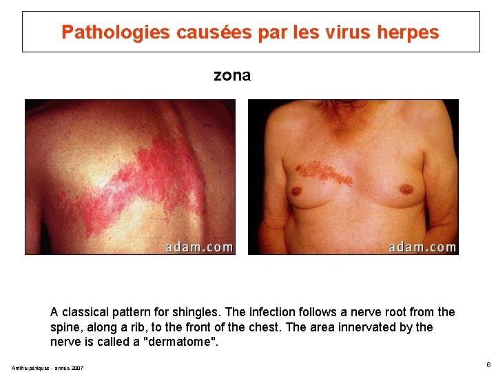 Pathologies causées par les virus herpes zona A classical pattern for shingles. The infection