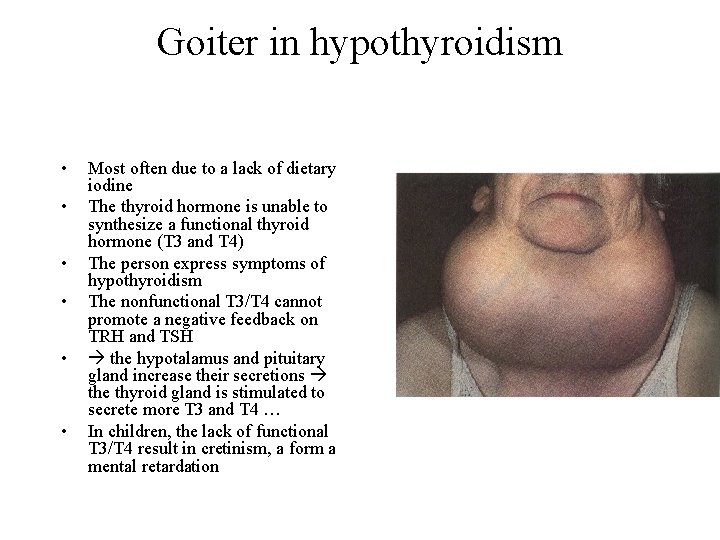 Goiter in hypothyroidism • • • Most often due to a lack of dietary