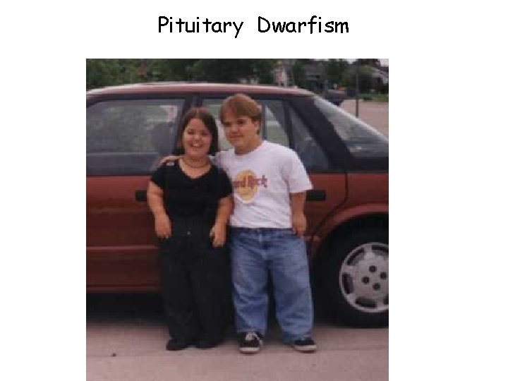 Pituitary Dwarfism 