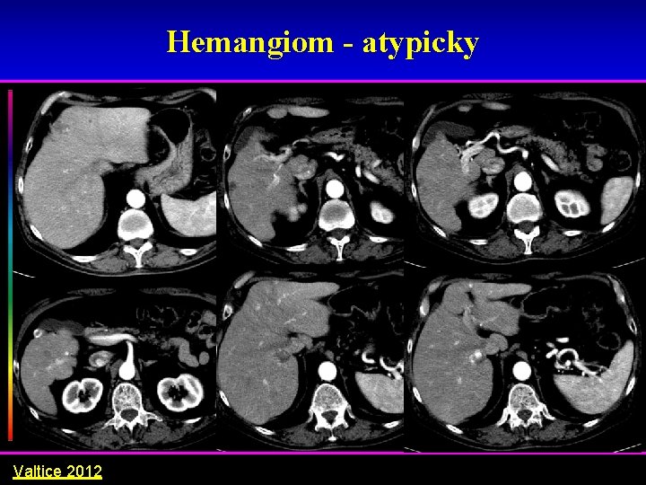 Hemangiom - atypicky Valtice 2012 