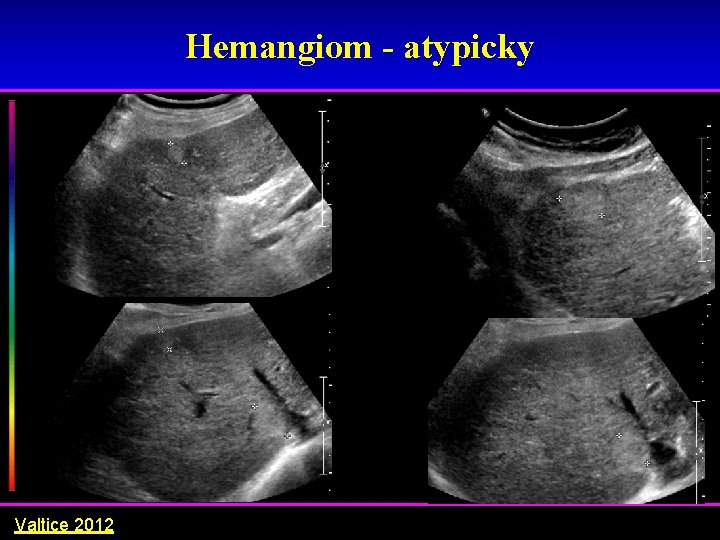 Hemangiom - atypicky Valtice 2012 