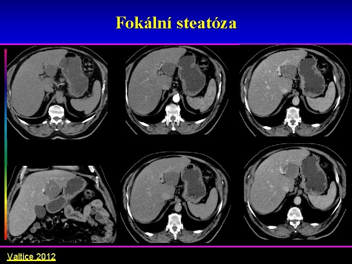 Fokální steatóza Valtice 2012 