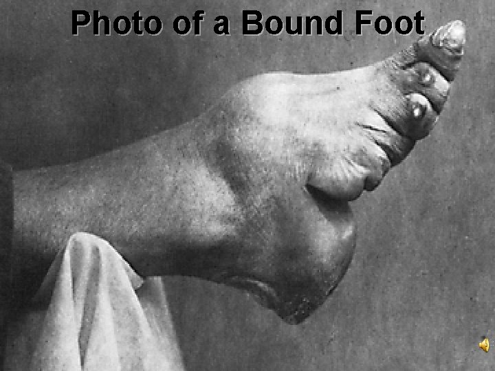 Photo of a Bound Foot 
