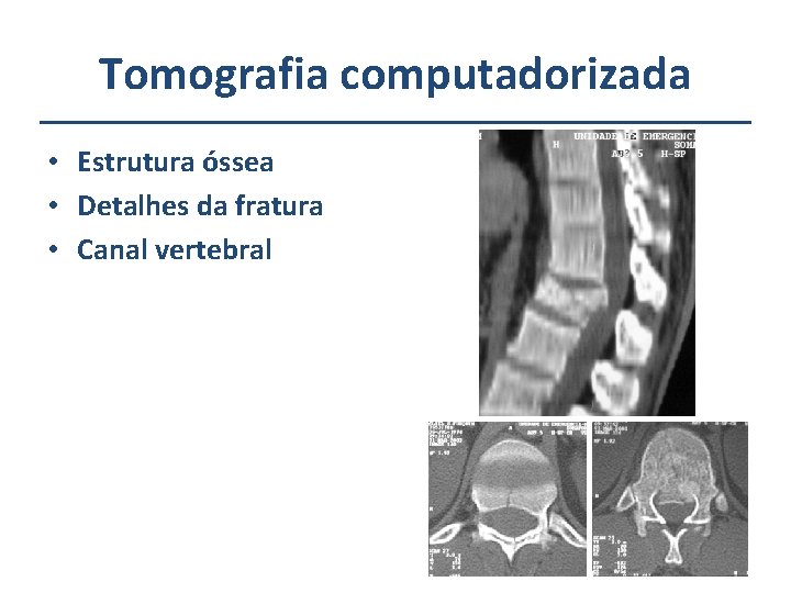 Tomografia computadorizada • Estrutura óssea • Detalhes da fratura • Canal vertebral 