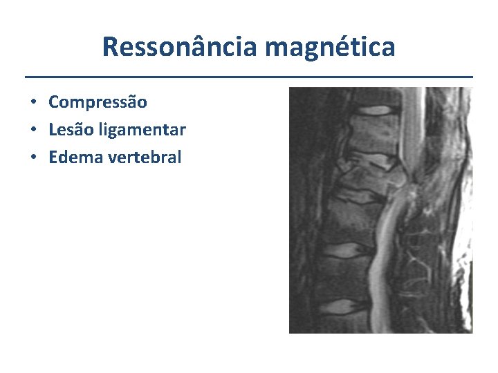 Ressonância magnética • Compressão • Lesão ligamentar • Edema vertebral 