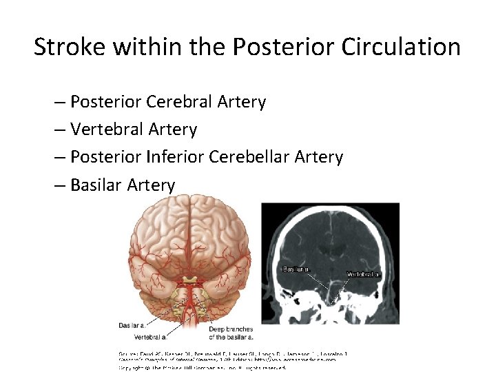 Stroke within the Posterior Circulation – Posterior Cerebral Artery – Vertebral Artery – Posterior