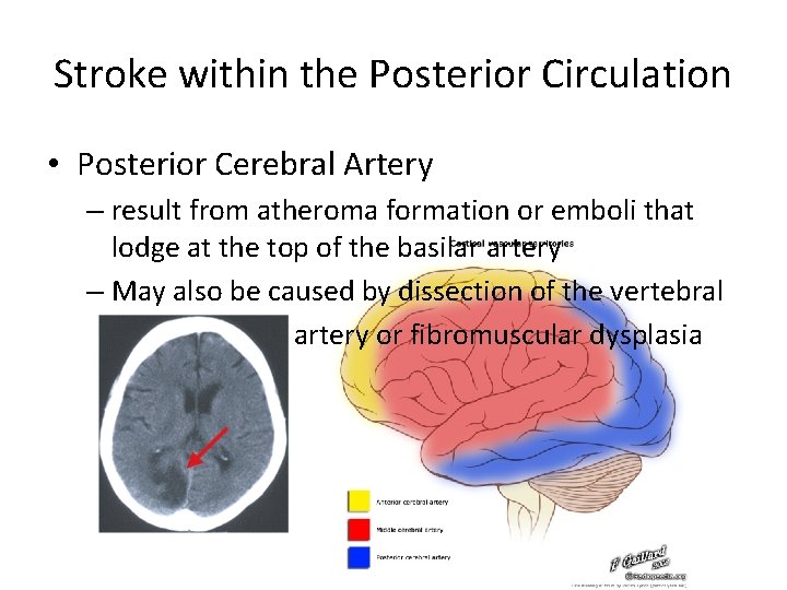 Stroke within the Posterior Circulation • Posterior Cerebral Artery – result from atheroma formation